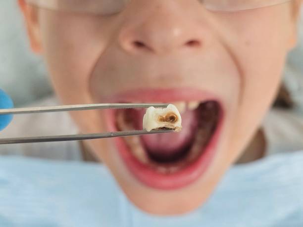 Best Broken or Cracked Tooth Emergency Dentist in Angels, CA